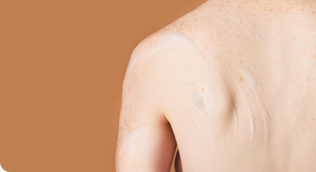 Close-up van de rug en schouder van een persoon met sproeten en vitiligo, waarop een dunne laag crème is aangebracht.