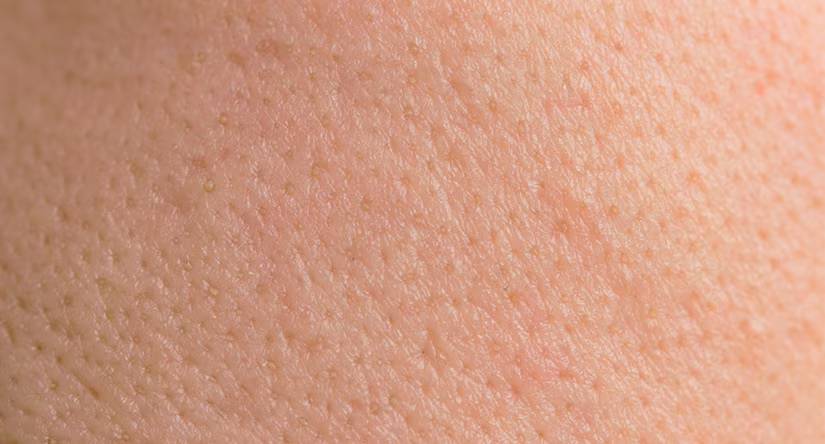 Extreme close-up van de huidtextuur, waarop duidelijk poriën en een lichte onregelmatigheid, vergelijkbaar met kippenvel, te zien zijn.